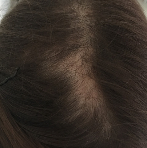 haarausfall wegen schuppen was sind