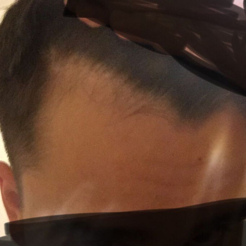 haarausfall wie lange noch gesundheit