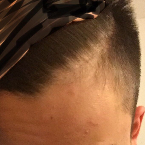 haarausfall wie lange noch gesundheit