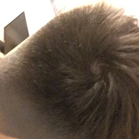 haarausfall wie lange noch gesundheit