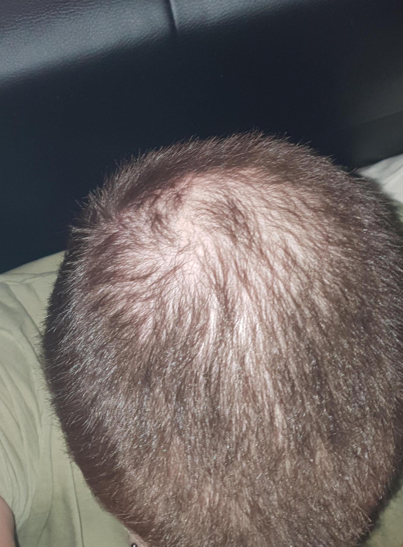 Haarausfall, wieso wachsen da keine Haare mehr