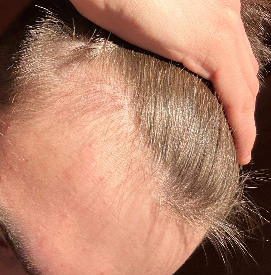 Haarausfall/Geheimratsecken mit 18, was gegen tun? (Männer, Pubertät, Pflege)