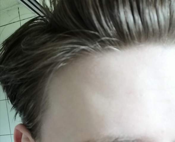 Haardichte Ist Ungleich Computer Haare Haarausfall