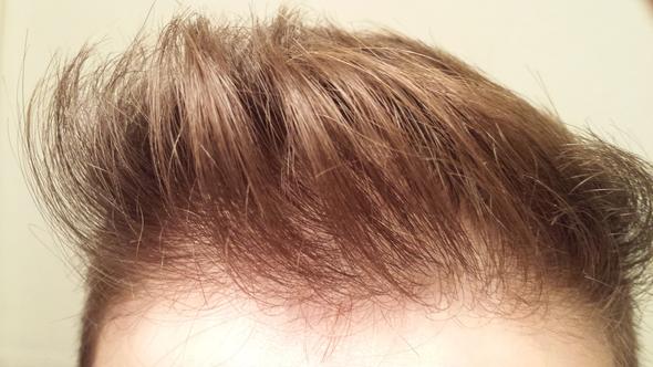 Haardichte Weniger Geworden Mannlich 18 Jahre Haare Menschen Arzt