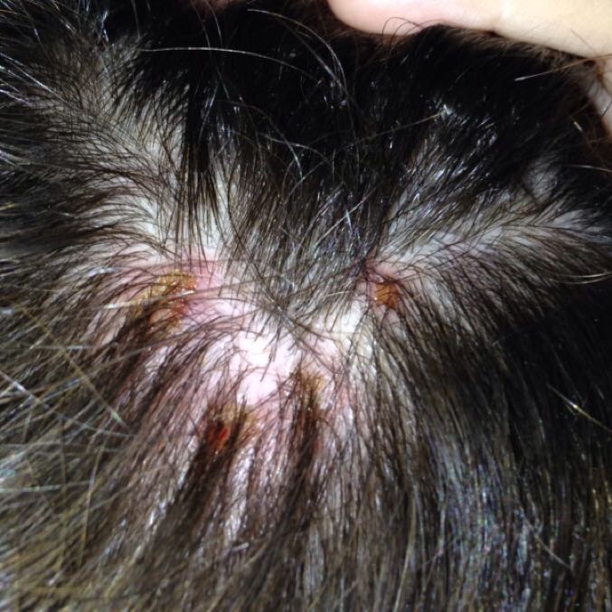 Haare färben, trotz Neurodermitis? (Gesundheit, Hautkrankheit)