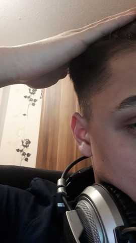 haarausfall geheimratsecken