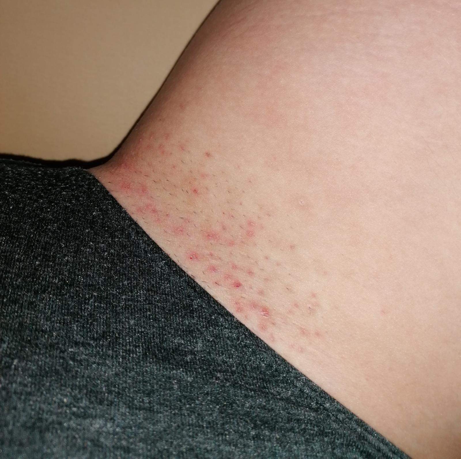 Axeln Rasieren Haarfreie Bikinizone und Achseln? (Beauty, Narben, Rasur)