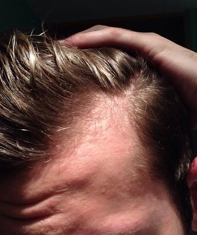 haartransplantation geheimratsecken