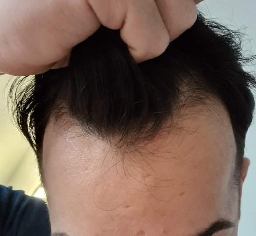 Haartransplantation mit 21? (Gesundheit und Medizin, Haare, Friseur)