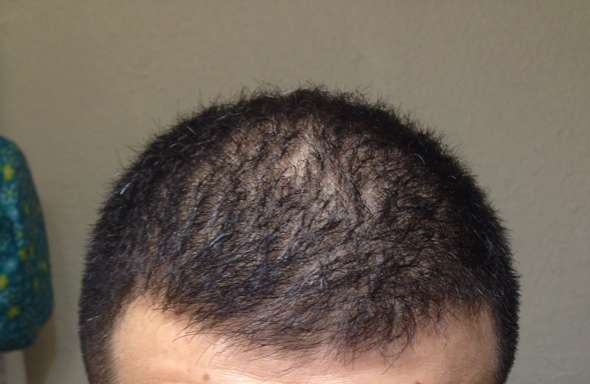 haarwurzeln geschwacht durch hitze