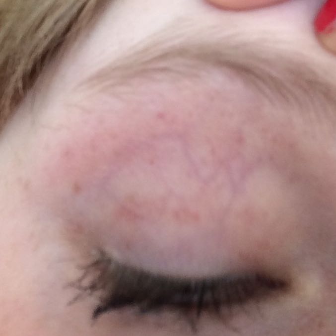Hab Blutflecken am Augenlid, was hat das zu bedeuten? (Mädchen, Arzt, Angst)