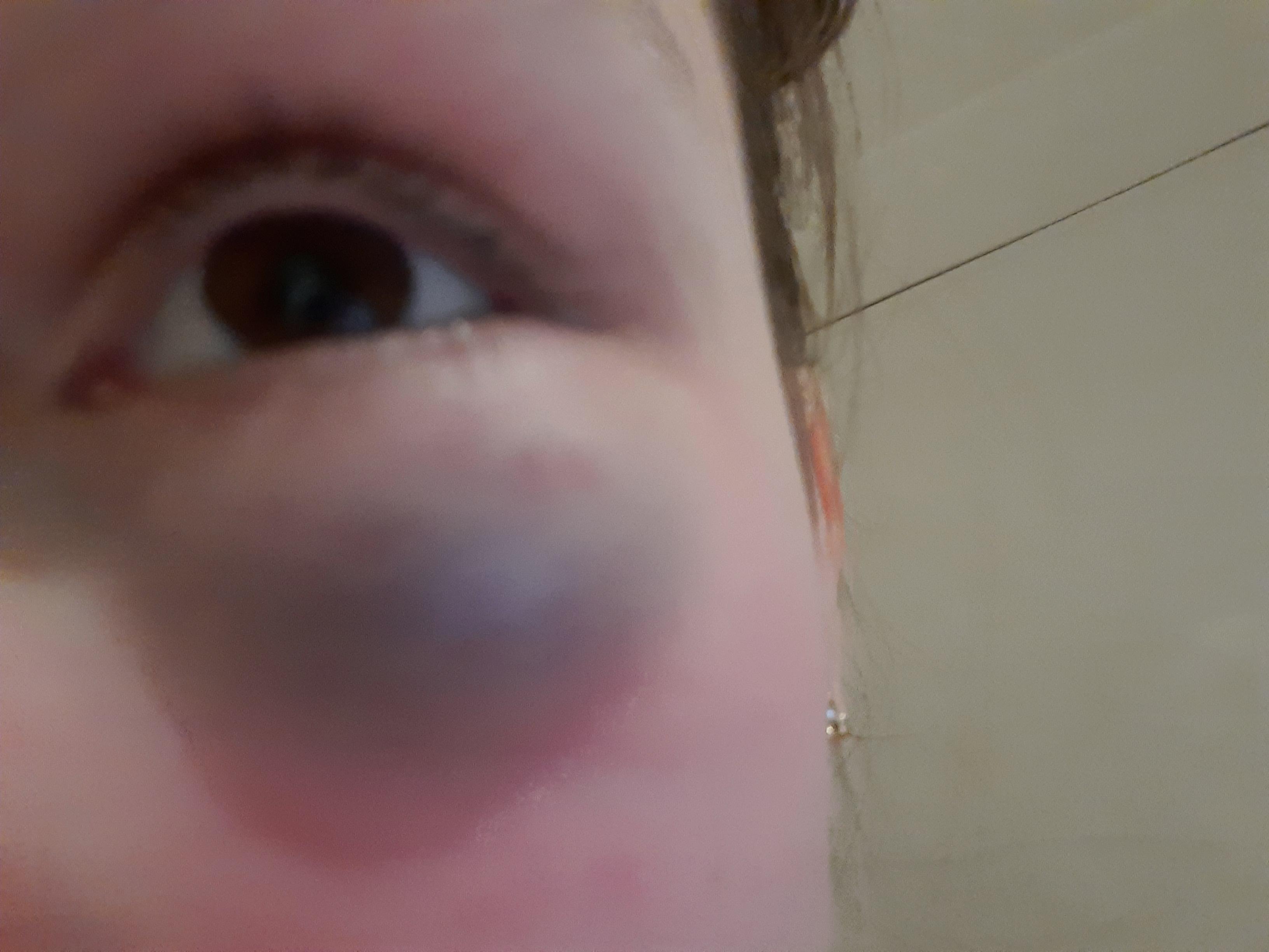 Wie Bekommt Man Ein Blaues Auge Weg