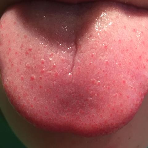 Ich Habe Ganz Viele Kleine Rote Blaschen Auf Der Zunge Was Ist Das Und Was Kann Ich Tun Rot Blaeschen Ich Habe Ganz Viele Kleine Rote Blaschen Auf Der Zunge Was Ist Das Und Was Kann Ich Tun Rot Blaeschen