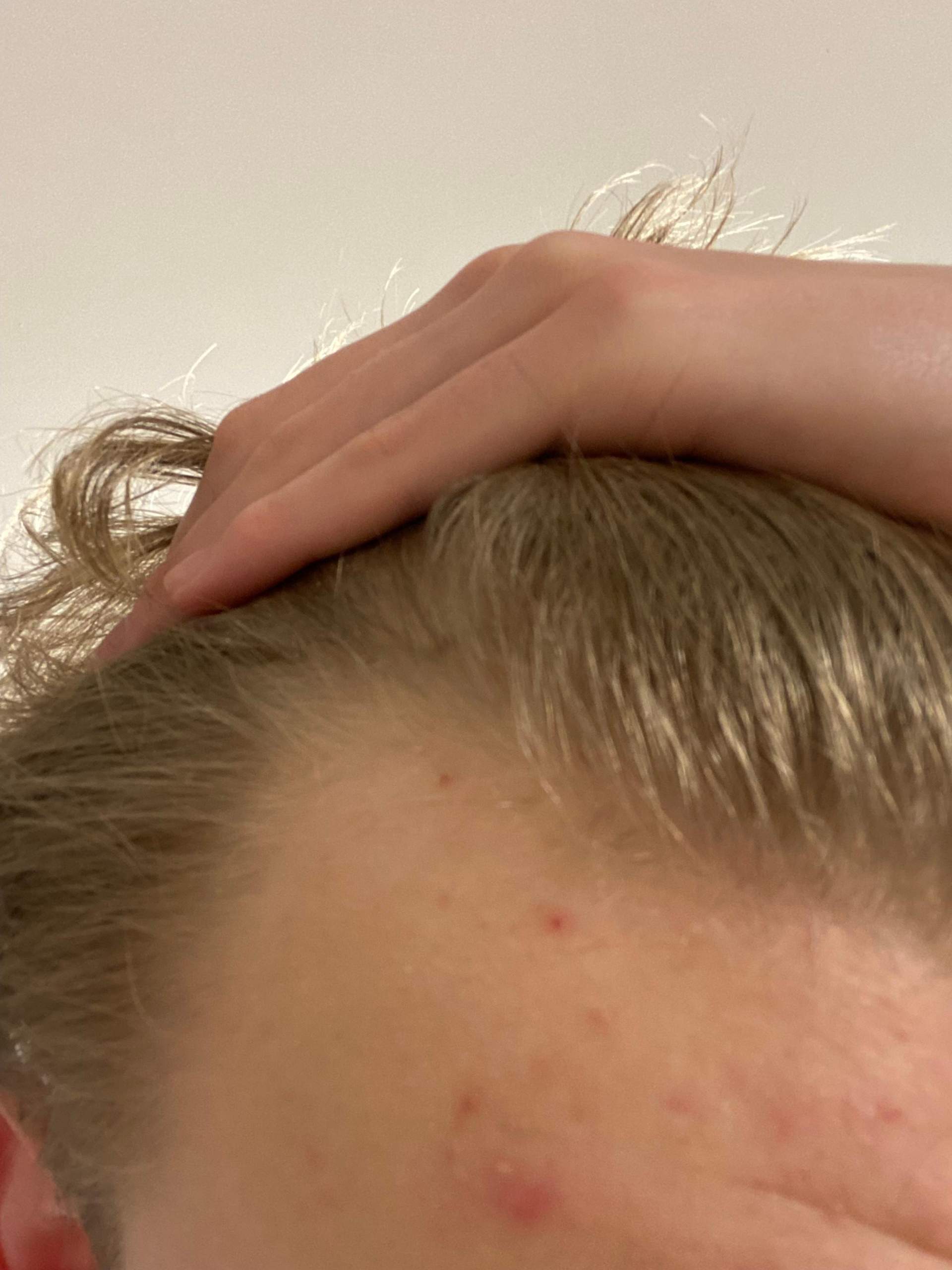 Hab ich bald keine Haare mehr? (Jungs, Haarausfall, Geheimratsecken)