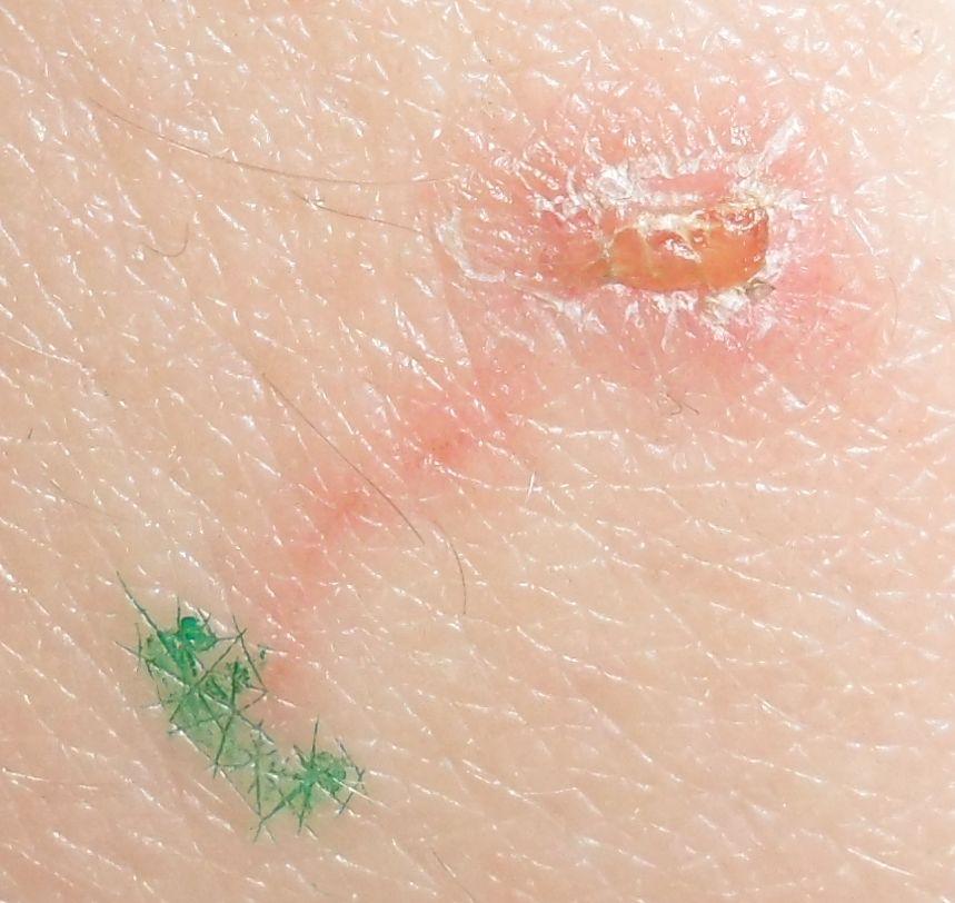 Habe ich eine Blutvergiftung? (Medizin, Psychologie, Arzt)