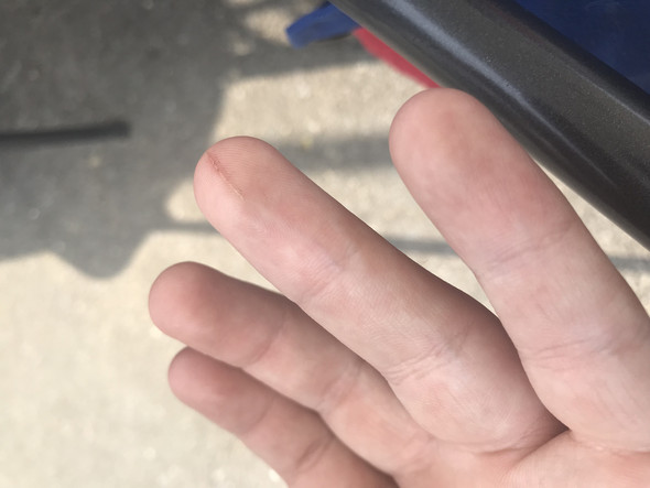 Hab Ich Eine Blutvergiftung Am Finger Gesundheit Hab Ich Eine Blutvergiftung Am Finger Gesundheit