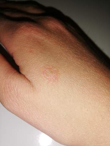 Hab Ich Flechte Rinderflechte Schuppenflechte Gesundheit Medizin Hautausschlag Hab Ich Flechte Rinderflechte Schuppenflechte Gesundheit Medizin Hautausschlag