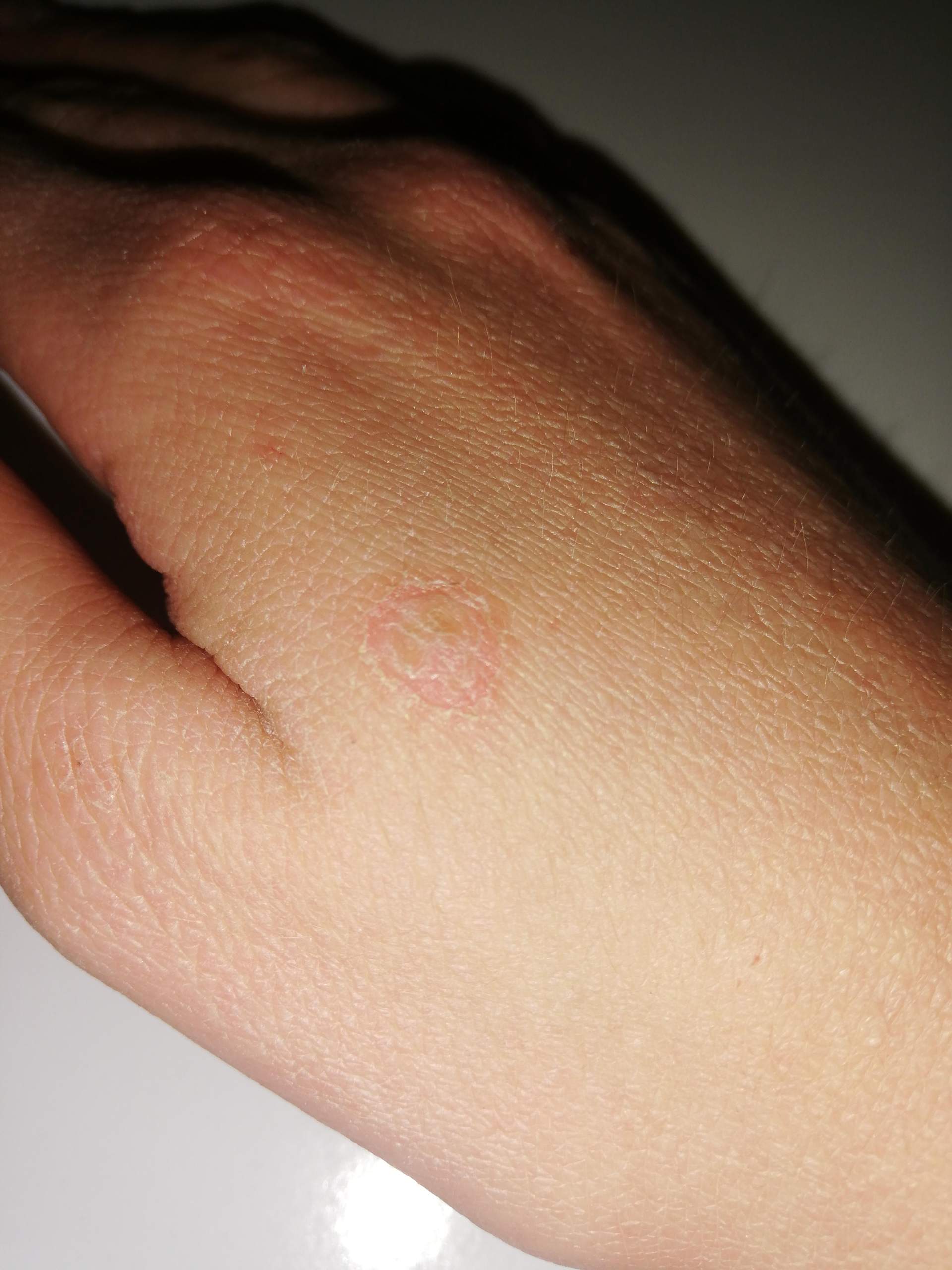 Hab ich Flechte/Rinderflechte/Schuppenflechte? (Gesundheit, Medizin ...