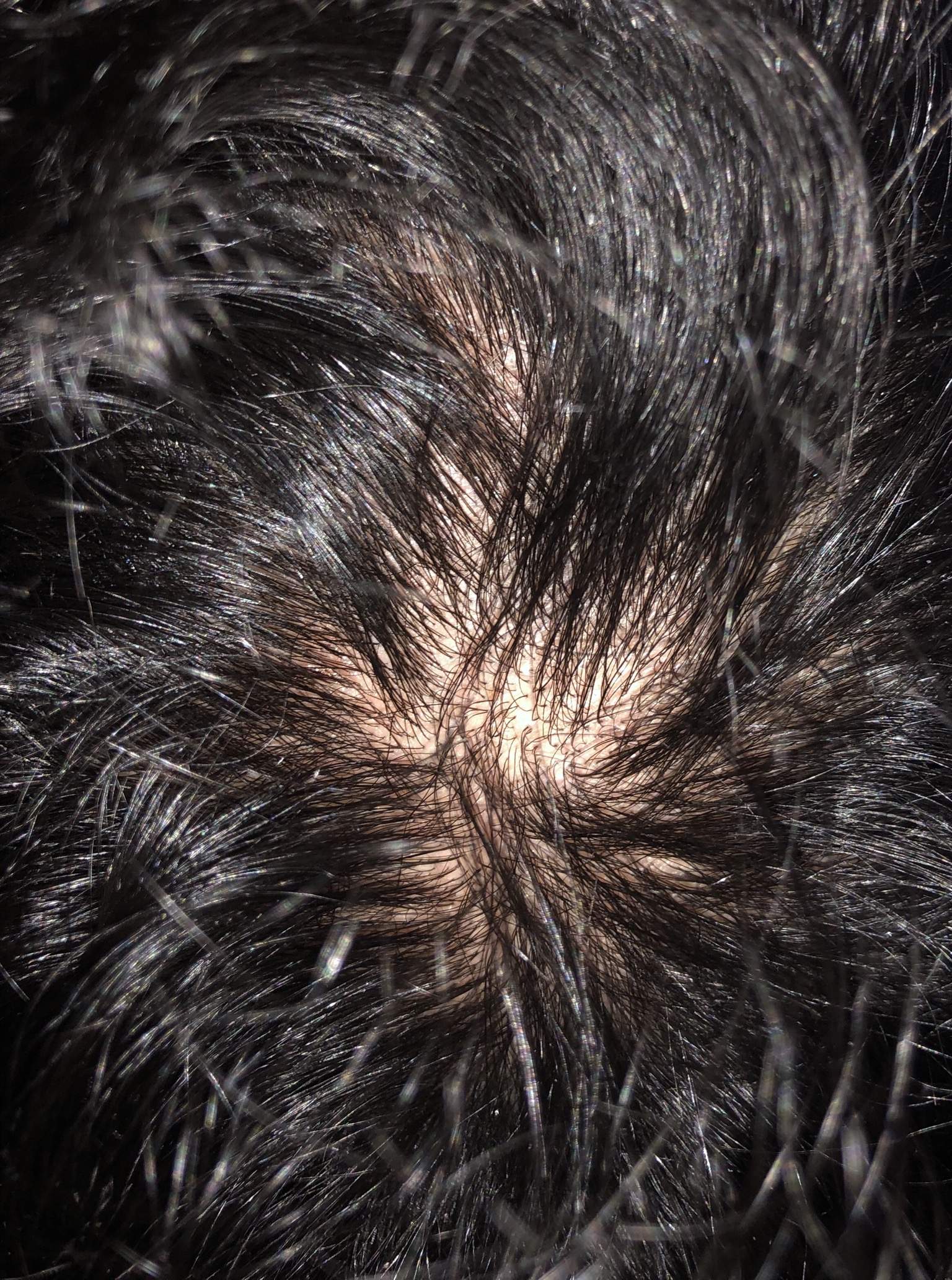 Frisur Bei Haarausfall Hinterkopf : Hab Ich Haarausfall ( Hinterkopf )? (gesundheit)