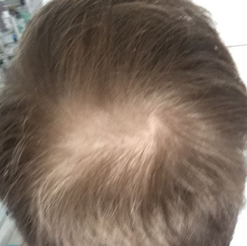 Hab Ich Haarausfall Bzw Werden Die Haare Dunner Gesundheit Und Medizin Gesundheit Ernahrung