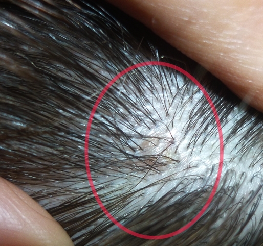Operative Dermatologie Im Kopfhalsbereich R P A Operative Dermatologie Im Kopfhalsbereich R P A