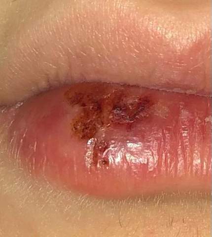 Hab Ich Herpes Lippe Hab Ich Herpes Lippe
