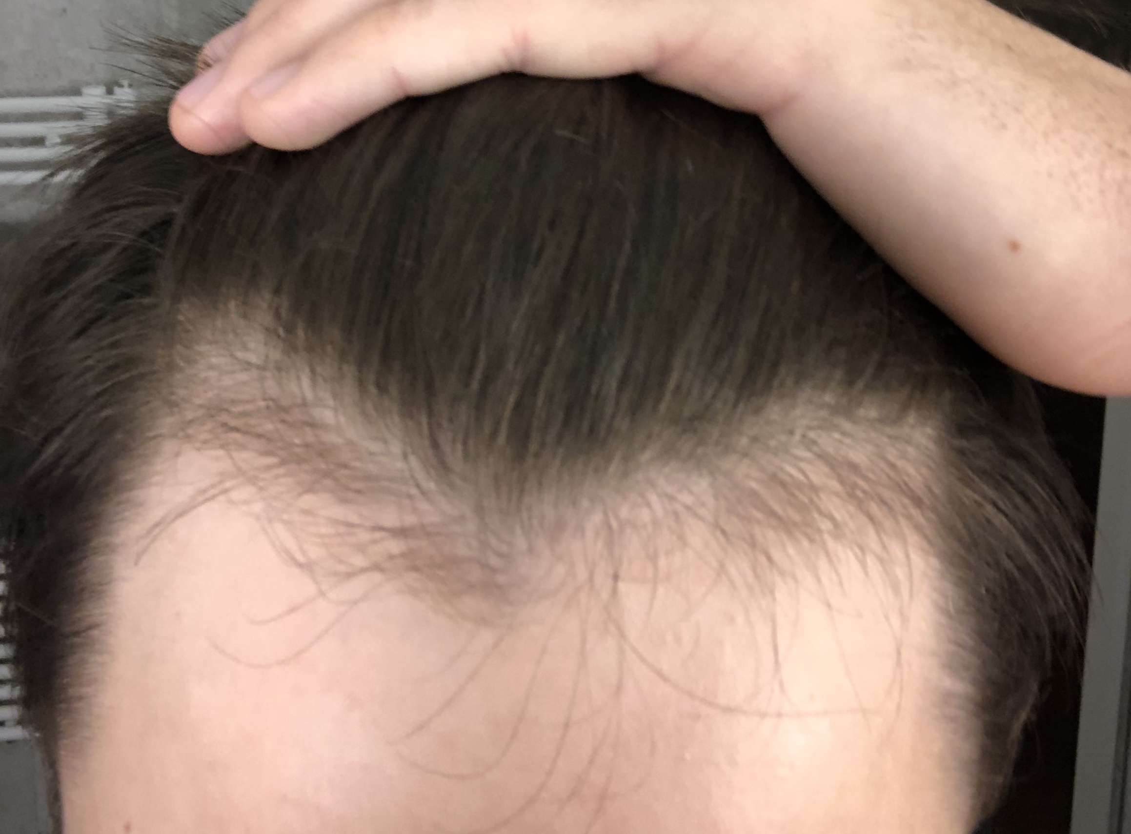 Hab ich schon Haarausfall? (Haare) schüsslersalze haarausfall