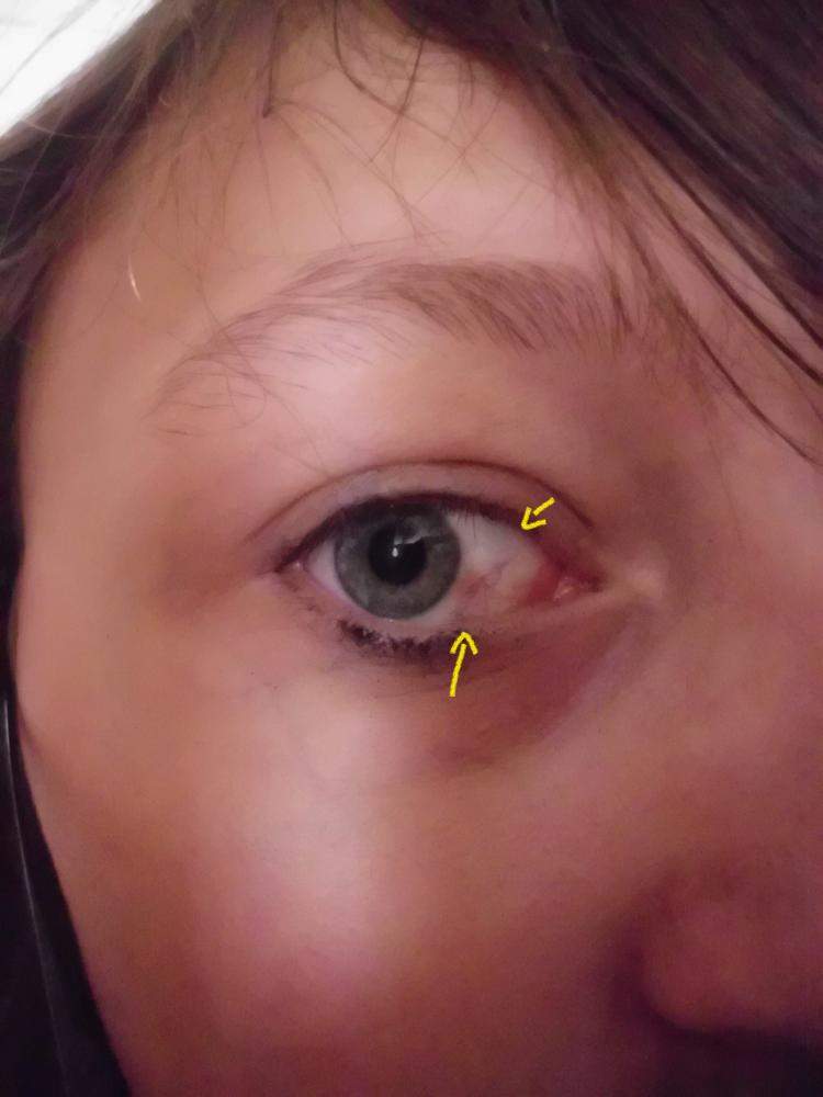 Hab Kleine Rote Adern Im Auge Schlimm Augen Hab Kleine Rote Adern Im Auge Schlimm Augen