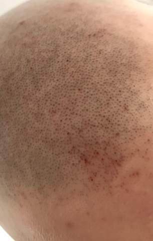 hab mich bei der rasur geschnitten