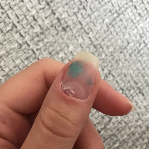 hab mit der nagelschere in meinen nagel geschnitten ist das schlimm gesundheit und medizin nagel