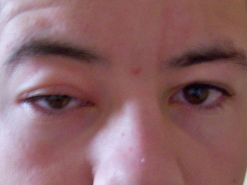 Hab So Eine Schwellung Zwischen Auge Und Augenbraue Gesundheit Augen Gesicht Hab So Eine Schwellung Zwischen Auge Und Augenbraue Gesundheit Augen Gesicht