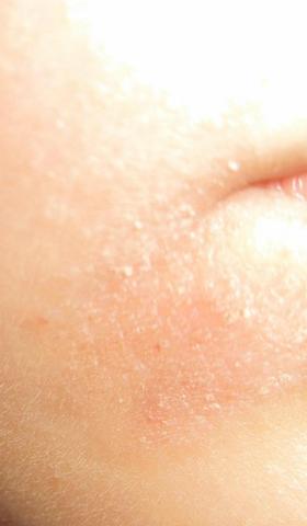 Habe Ein Paar Extrem Trocken Hautstellen Beauty Haut Pflege