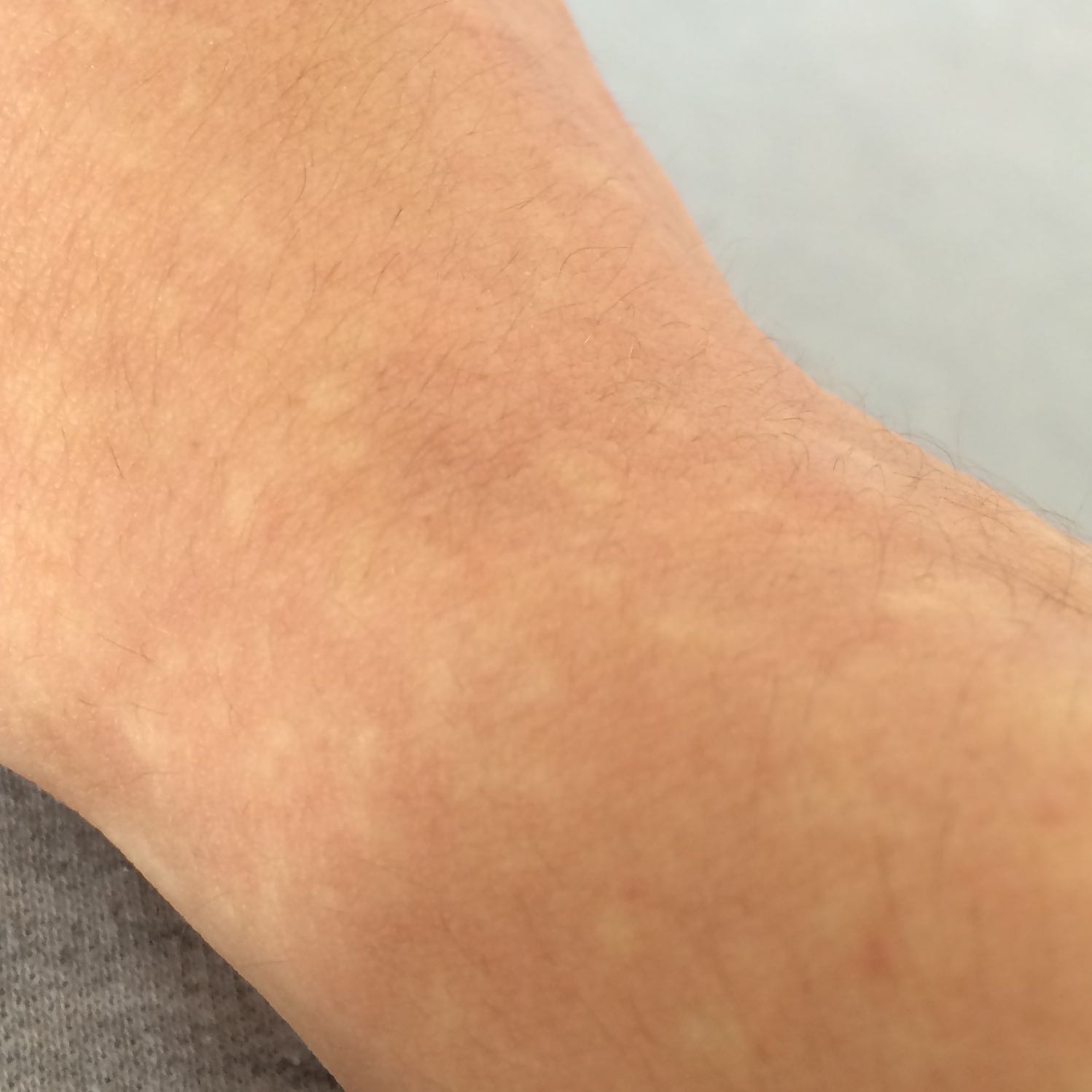 Habe an meinen beiden Armen kleine weisse Punkte, die aber nur ab und Habe an meinen beiden Armen kleine weisse Punkte, die aber nur ab und