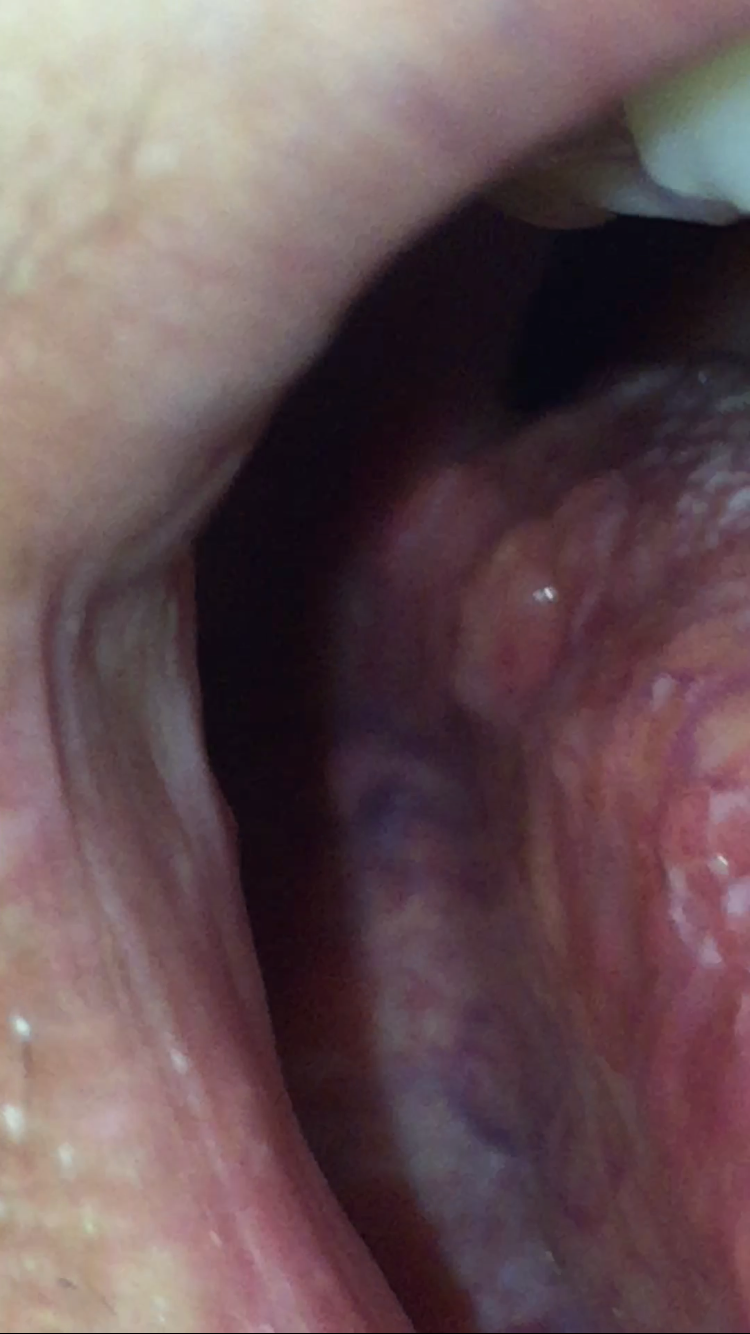 Download Pickel Auf Der Zunge Ausdrücken Pics