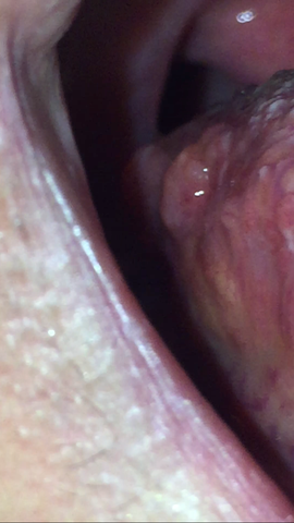 36+ Pickel Auf Der Zunge Hinten Erkältung Pictures