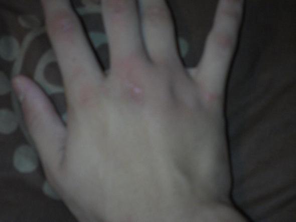 Hand  - (Krankheit, Verletzung)