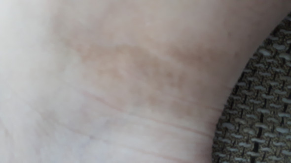 Habe Braune Flecken Am Fuss Gesundheit Und Medizin Medizin Arzt Habe Braune Flecken Am Fuss Gesundheit Und Medizin Medizin Arzt