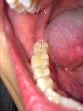 Der letzte Zahn  - (Zähne, Zahnarzt, Karies)
