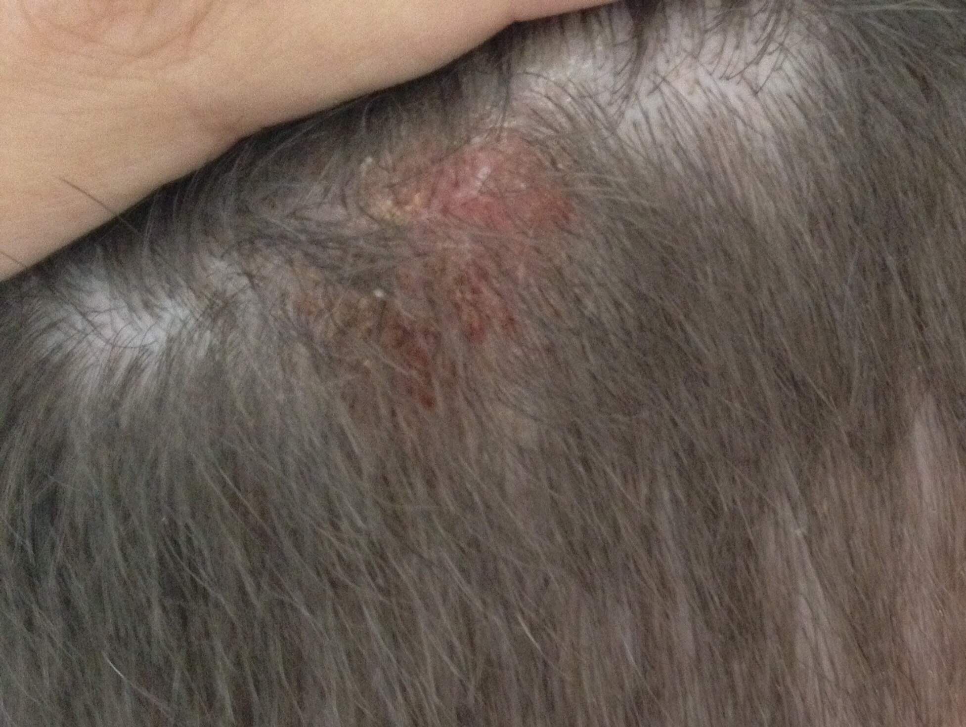 Habe eine wunde am kopf, die schon seit ungefähr 3 monaten nicht