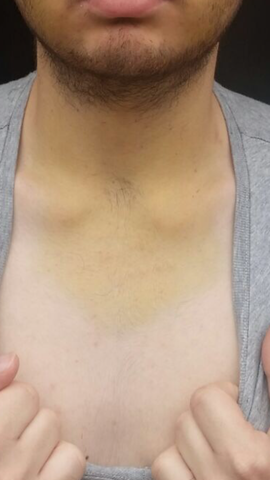 Habe Einen Gelben Bluterguss Bis Zum Hals Nach Einer Weisheitszahn Op Ist Das Normal Weisheitszahn Op Habe Einen Gelben Bluterguss Bis Zum Hals Nach Einer Weisheitszahn Op Ist Das Normal Weisheitszahn Op