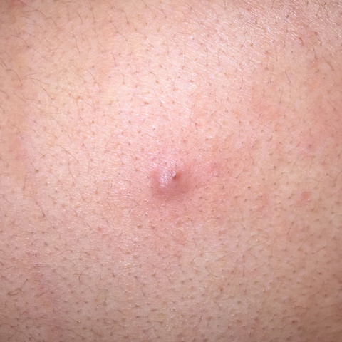 Habe Einen Harten Pickel Artigen Auf Dem Rucken Der Sich Nicht Ausdrucken Lasst Und Nicht Weg Geht Was Konnte Das Sein Gesundheit Medizin Haut