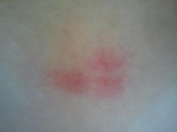 - (Rötung, Zeckenbiss, Borreliose)