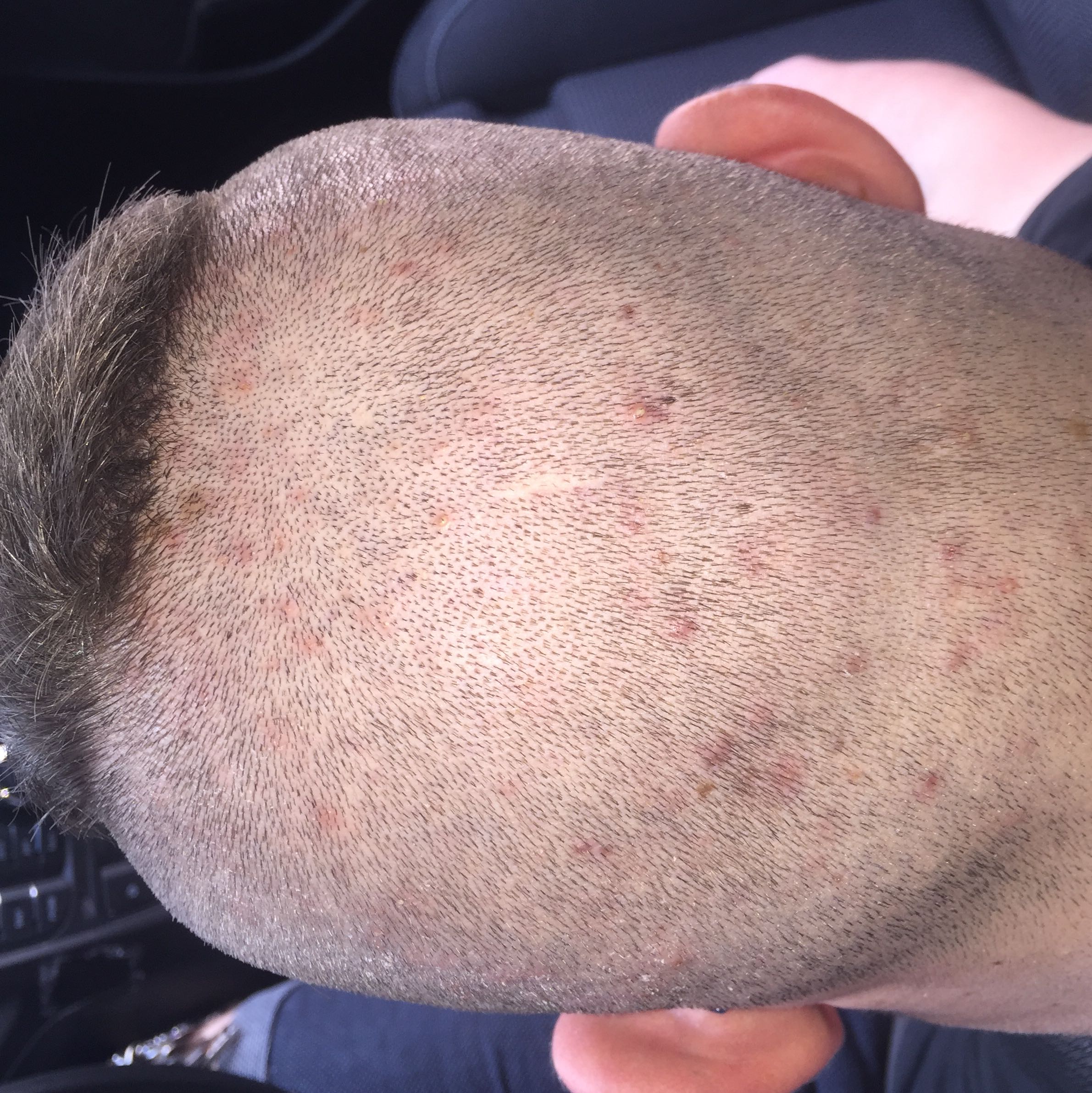 pickel am kopfhaut pickel am kopfhaut