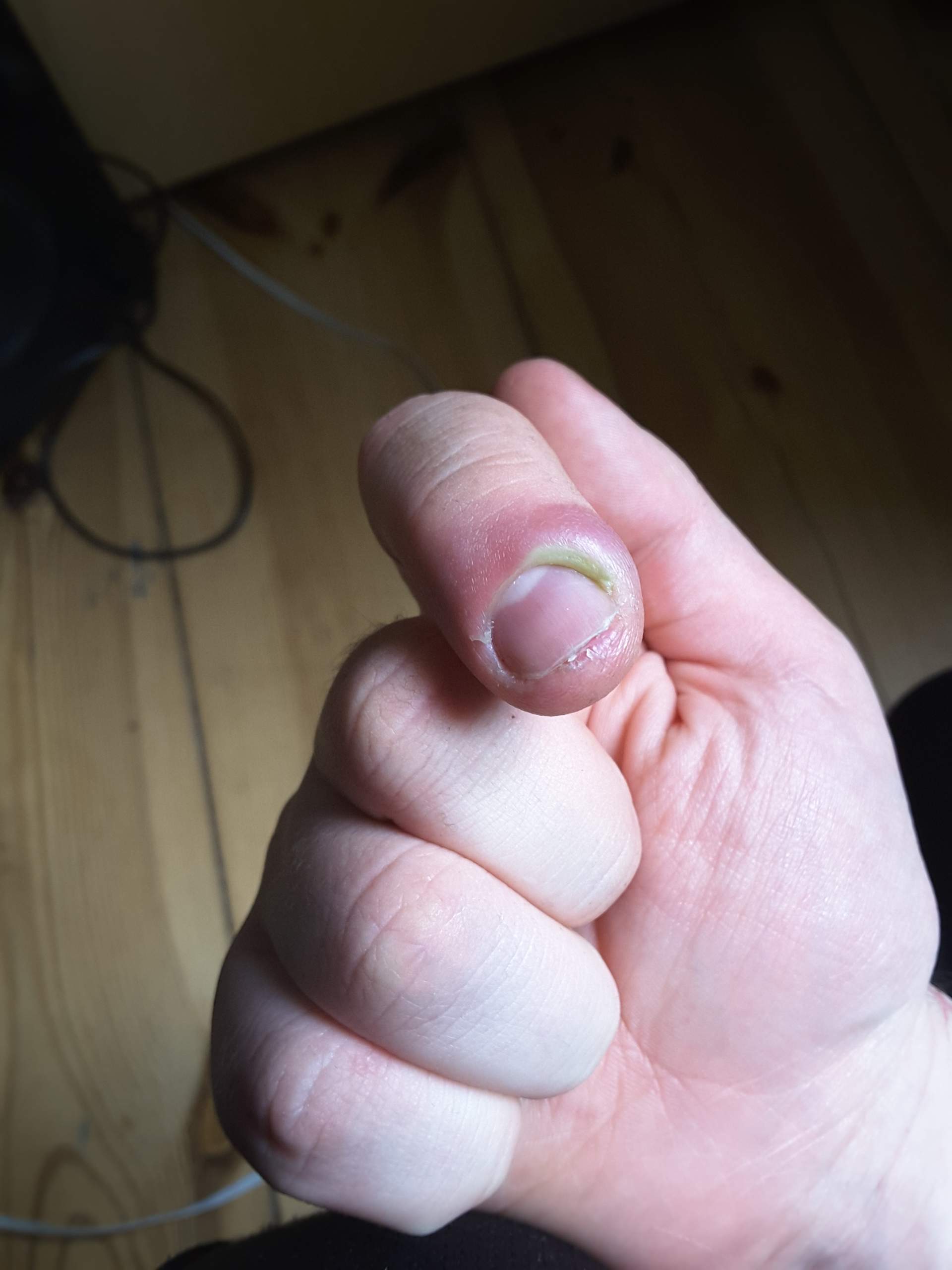 Habe habe diese Schwellung seit circa fünf Tagen am Finger. Ist das