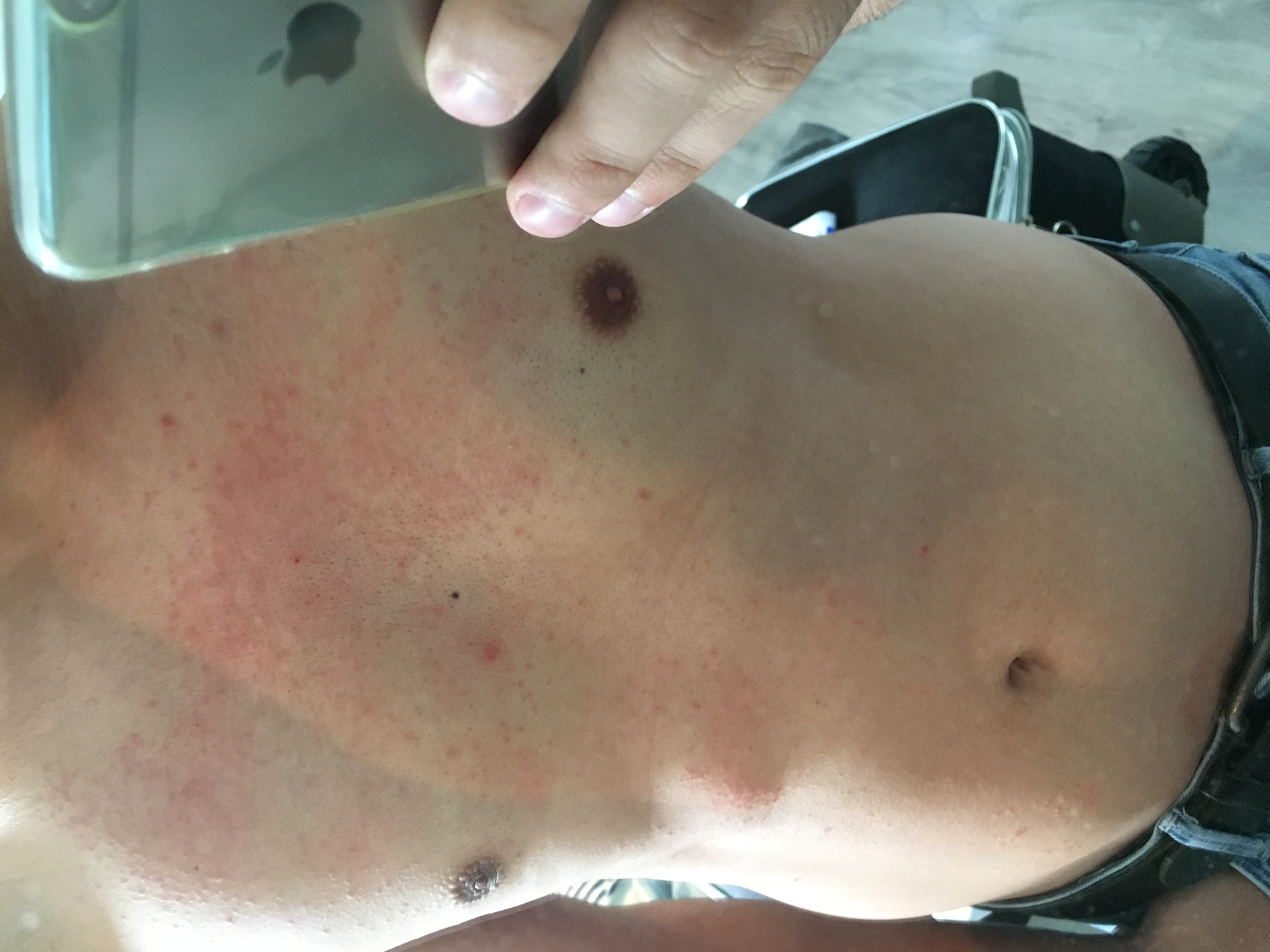 habe heute eine Enthaarungscreme benutzt und auf meiner ganzen brust habe heute eine Enthaarungscreme benutzt und auf meiner ganzen brust