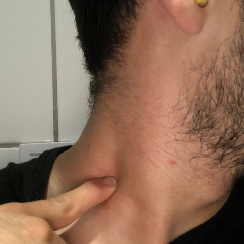 Habe Hier Eine Schwellung Am Hals Und Wenn Ich Auf Die Schwellung Draufdrucke Spure Ich Was Hartes Gesundheit Und Medizin Arzt Knochen Habe Hier Eine Schwellung Am Hals Und Wenn Ich Auf Die Schwellung Draufdrucke Spure Ich Was Hartes Gesundheit Und Medizin Arzt Knochen