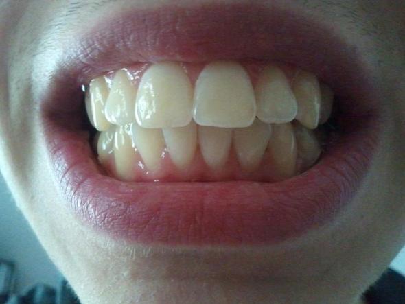 Zahnfleisch ist voll weit unten - (Zähne, Zahnspange, Zahnfleisch)