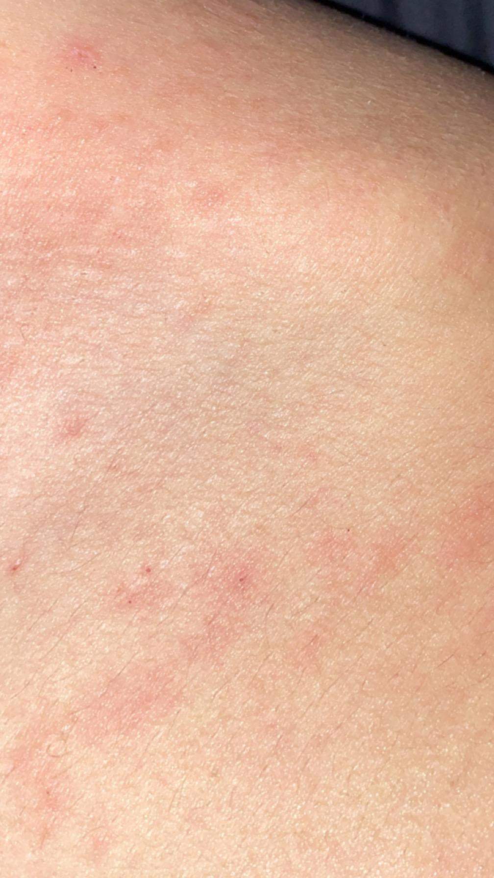 Habe ich Bettwanzen? (Medizin, Schädlinge, Flöhe)
