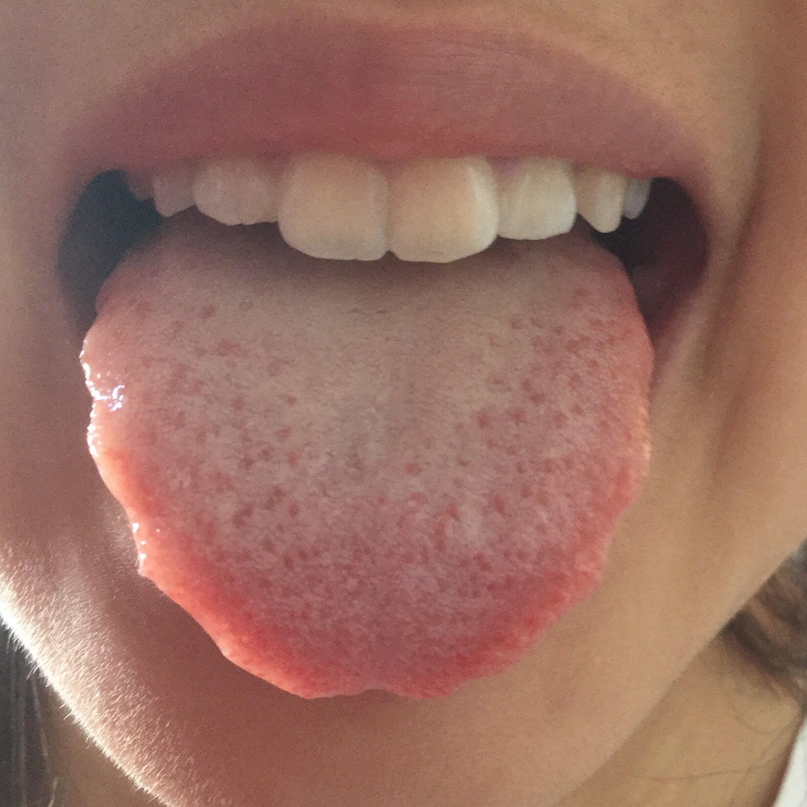 Habe ich Candida/Leaky Gut Syndrom? (Zungenbild)? (Gesundheit und Habe ich Candida/Leaky Gut Syndrom? (Zungenbild)? (Gesundheit und