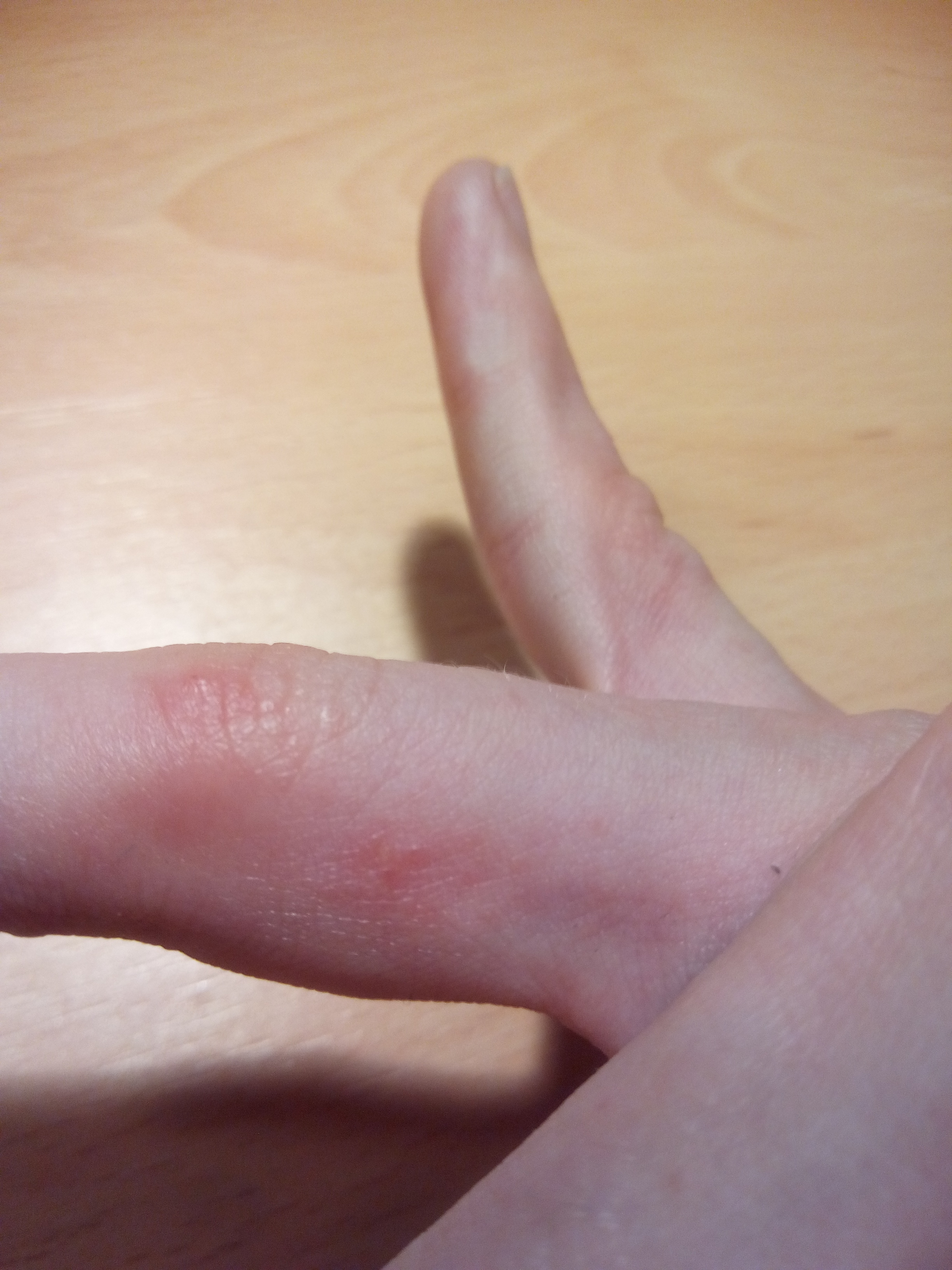 Habe ich die Krätze? Bild folgt unter diesen Beitrag? (Gesundheit und